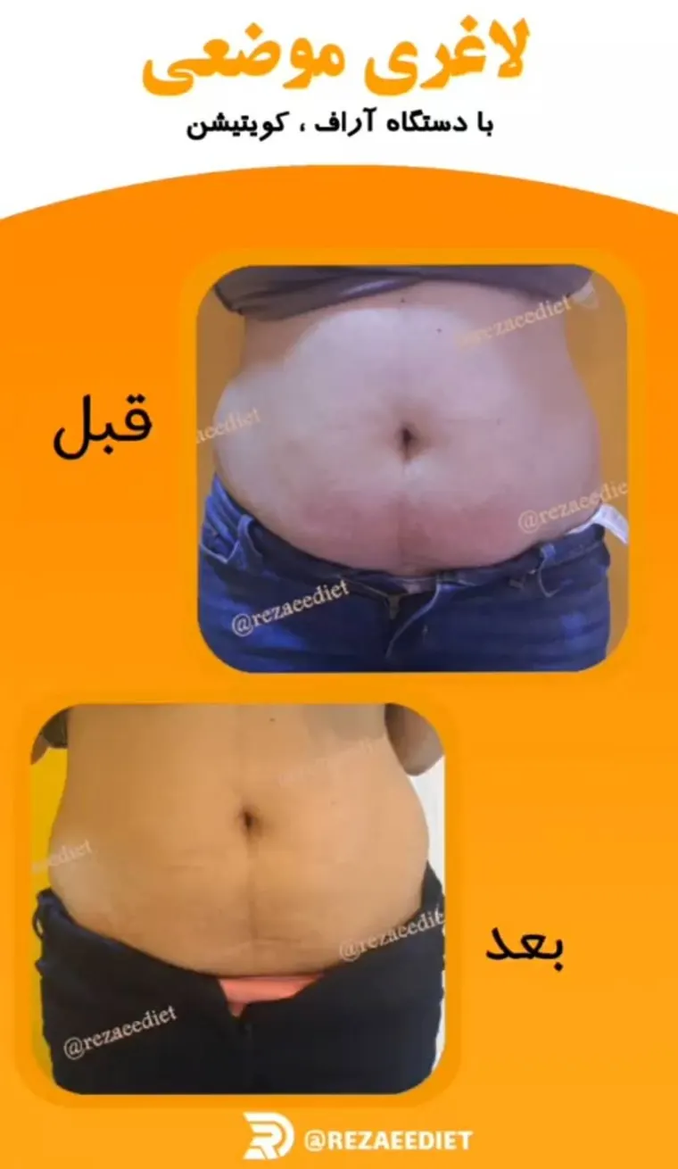 نتیجه واقعی لاغری موضعی شکم قبل و بعد از درمان با آراف کویتیشن