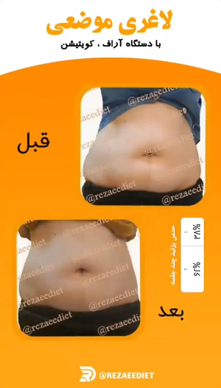 نتیجه واقعی دیگر از لاغری موضعی شکم قبل و بعد از درمان