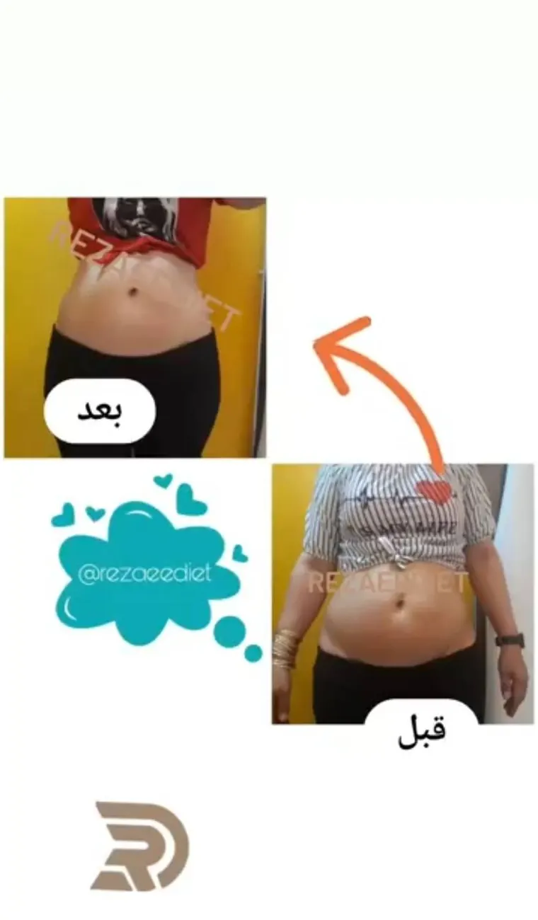 نتیجه واقعی کاهش سایز شکم قبل و بعد از لاغری موضعی