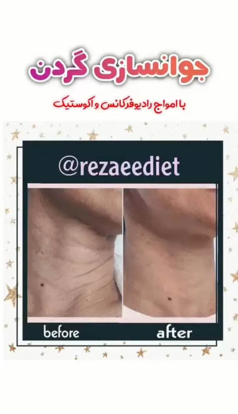 جوانسازی گردن با امواج رادیوفرکانس و اکوستیک، قبل و بعد
