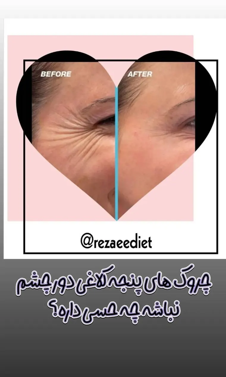 کاهش چروک‌های پنجه کلاغی دور چشم قبل و بعد از درمان با دستگاه رادیوفرکانس