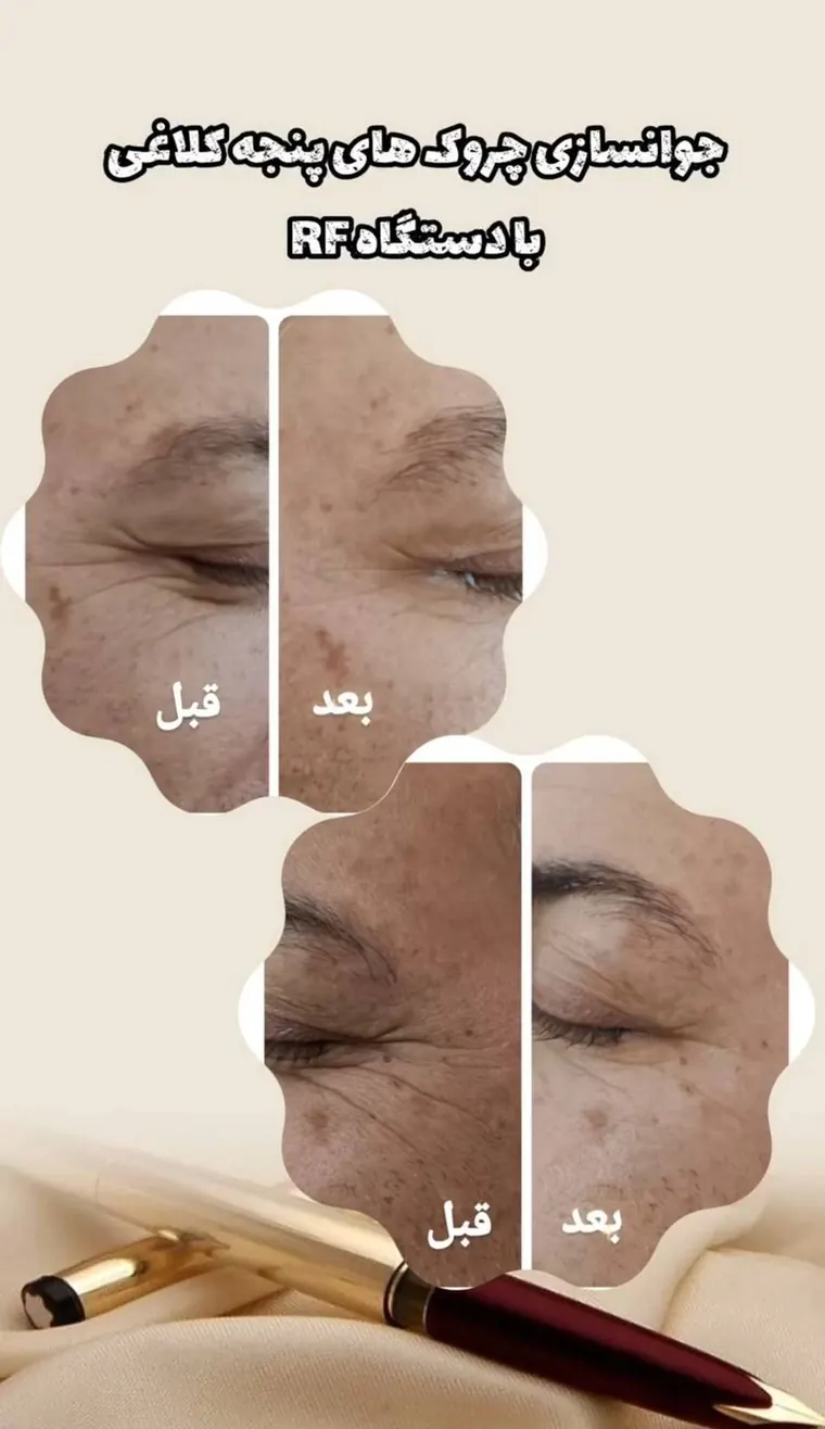 کاهش چروک‌های پنجه کلاغی دور چشم با دستگاه آراف، قبل و بعد